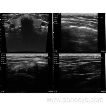 Super Width Linear Ultrasound Scanner for Breast Inspect